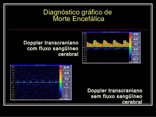 Como é Realizado o Doppler Transcraniano