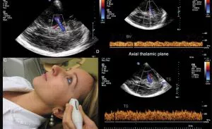 Vamos Falar sobre Doppler Transcraniano?