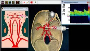 Vamos Falar sobre Doppler Transcraniano?